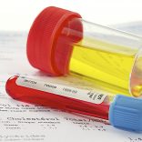 Hoe wordt een vitamine B12 tekort in het Catharina Ziekenhuis vastgesteld?