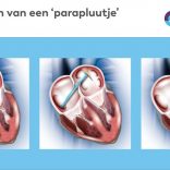 ‘Parapluutje’ kan jonge en fitte patiënt zekerheid bieden na beroerte